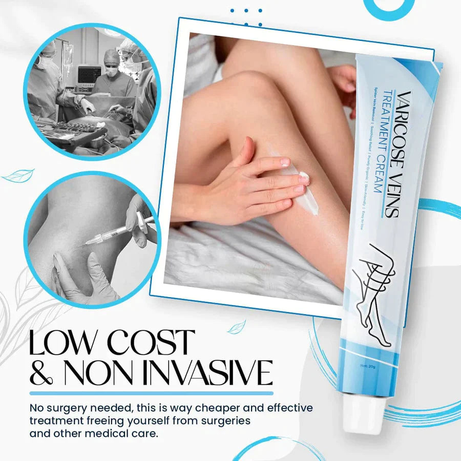 Varicose Veins Cream